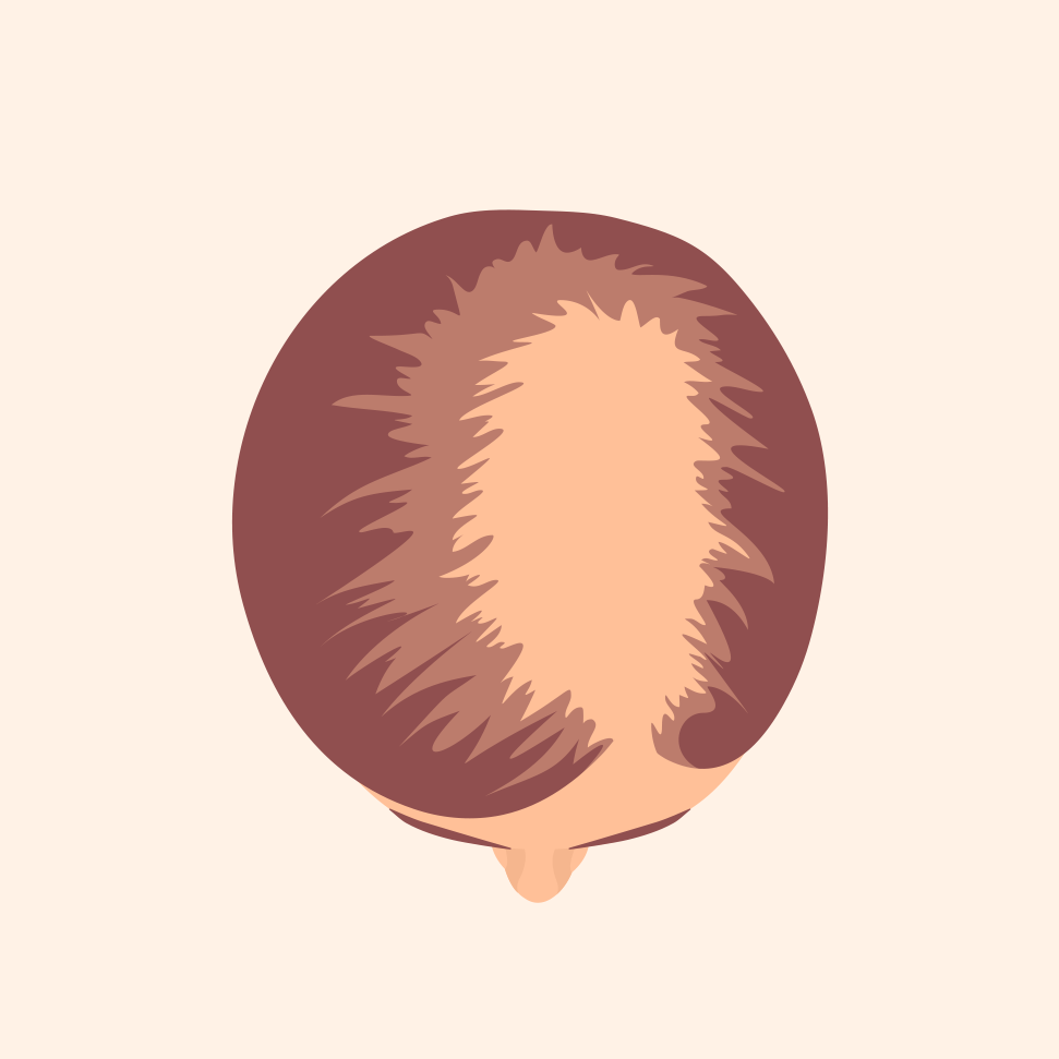 Stage 3